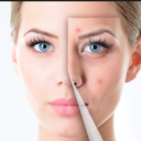 acne-breakout-diet-remedies-blog