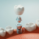 all-about-dental-implants
