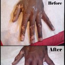 vitiligo-treatment-mumbai